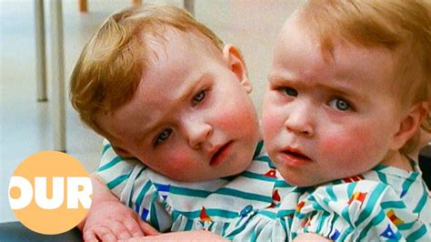 eilish twins|katie and eilish conjoined twins.